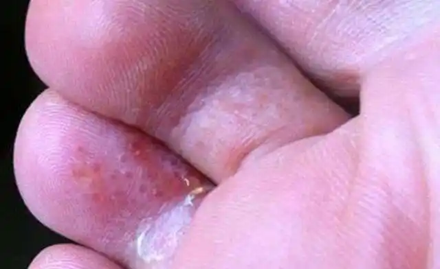 水泡型脚癣怎么治?茄子根和烟灰你不能错过!