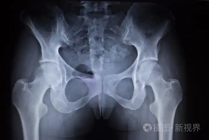 x 射线髋关节人类骨骼的骨科扫描的图像照片-正版商用图片0c3g44-摄图