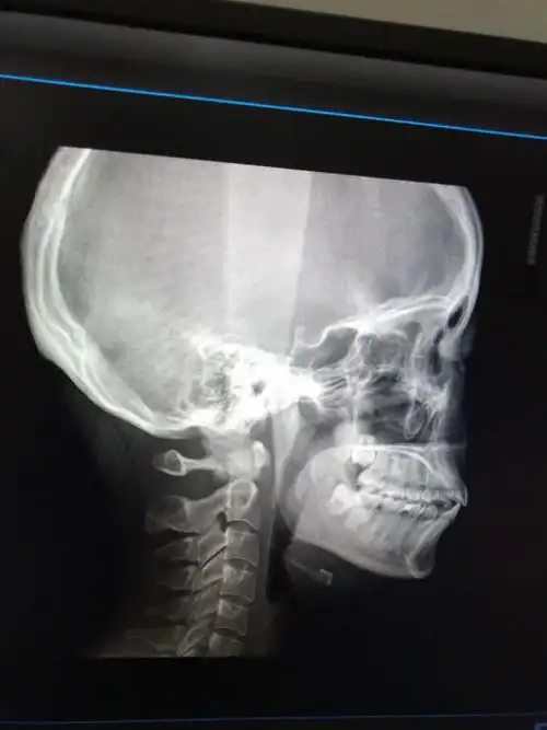 你好,我想问下我这个是骨性还是牙性,要是正畸可以改善嘴凸吗希望获得