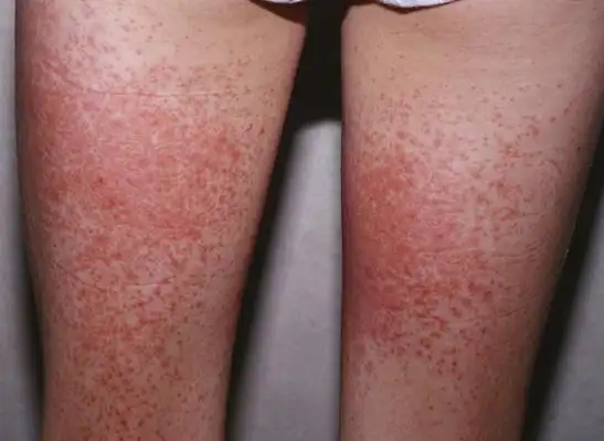 艾滋病红疹症状图片 (6)