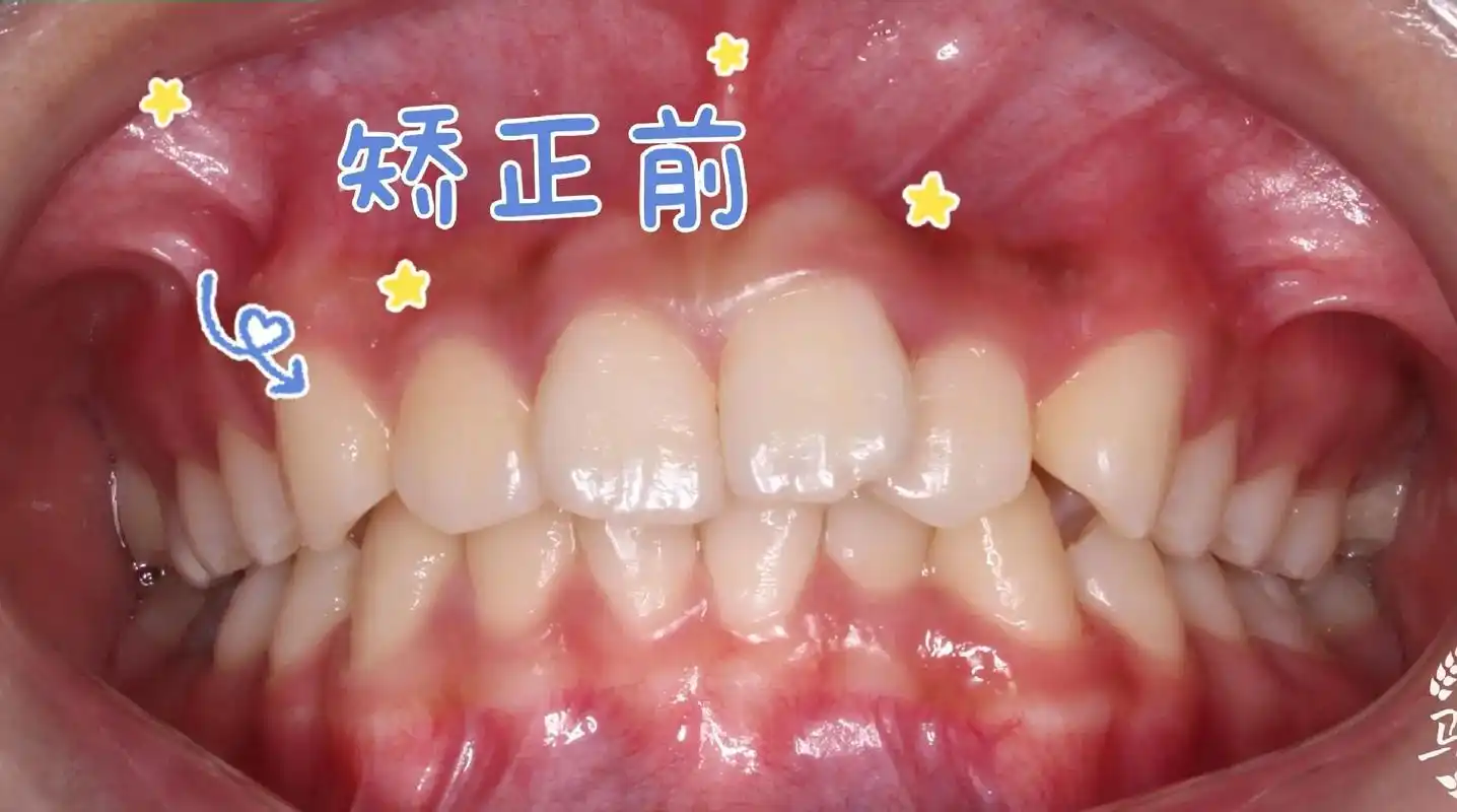 牙齿矫正.矫正牙齿是个漫长的的过程,你的等待惊艳了时光,愿未 - 抖音