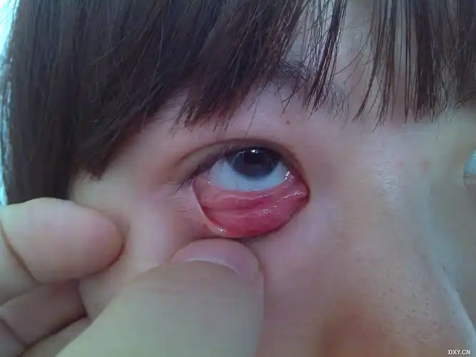 【眼表疾病讨论】眼科首诊1例罕见结膜--非霍奇金淋