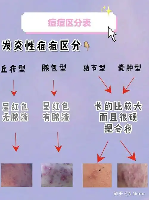 三,如何判断痤疮的严重程度