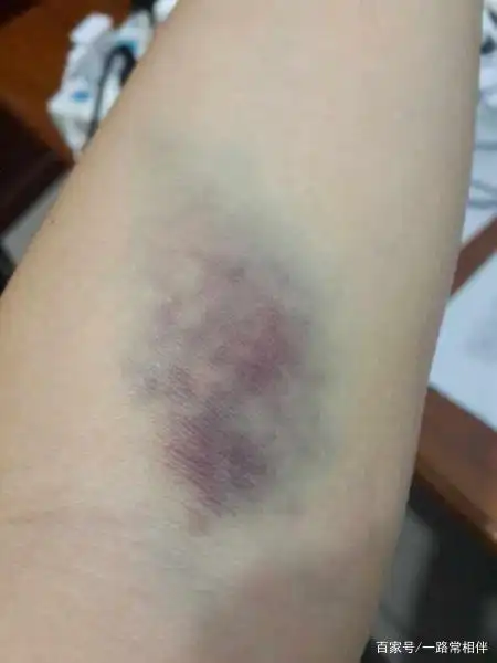 避免抽血后鼓包或青紫,2个诀窍要牢记