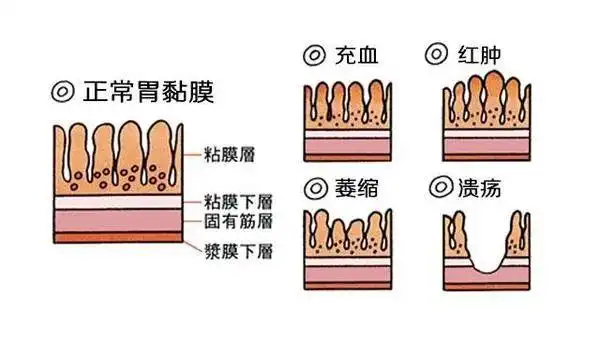 这10类人容易得胃癌医生告诉你怎么筛查
