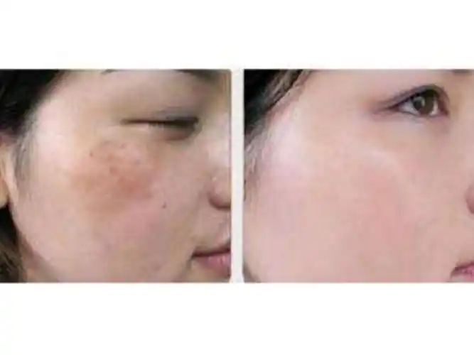 光子祛斑和激光祛斑有什么不同?