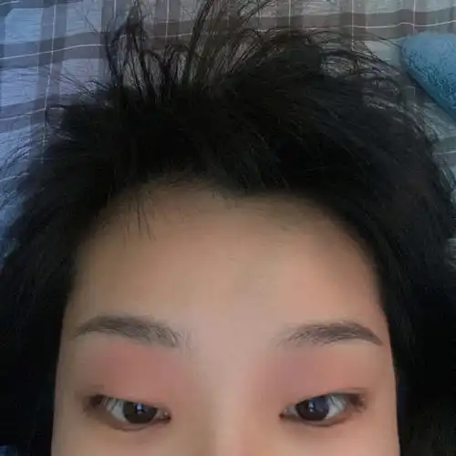 神经性皮炎反复好苦恼!救救孩子吧!(更新