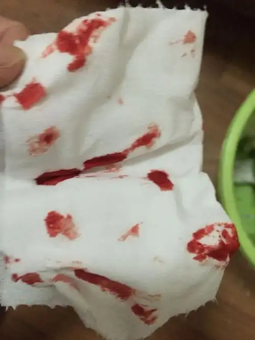 今天和朋友吃了韩国料理,我最近感冒,到了下午鼻子出血,我朋友和我