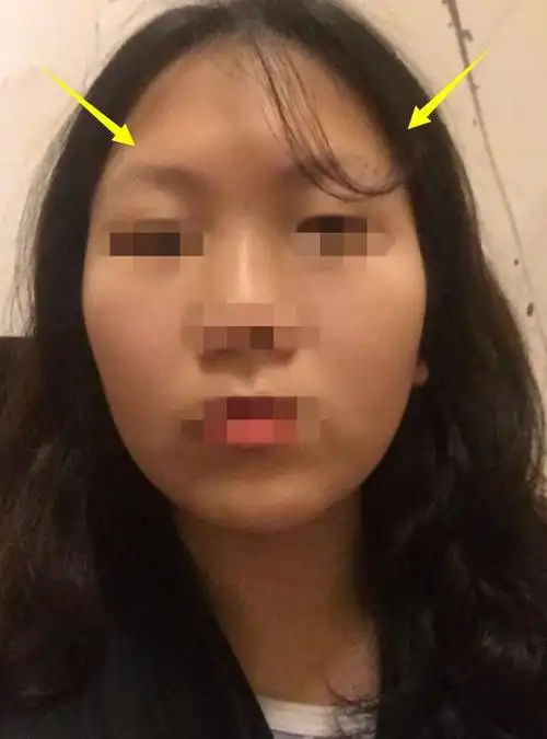 脸颧骨宽的脸型图