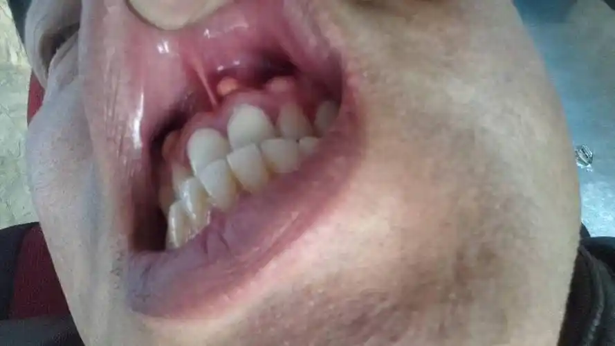 我的左门牙上边长一绿豆大小的肉疙瘩,不疼不痒,就是磨嘴唇,怎么了?