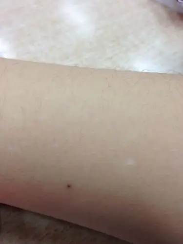 胳膊上有小白点,10多个吧,以前没有.白点直径1-2mm.摸起来有点凹下去.