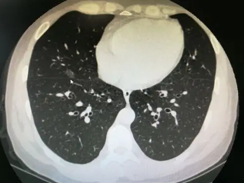 图文教你看懂恶性肺结节的ct表现