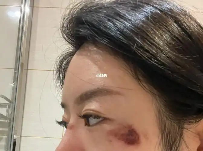 脸部擦伤第14天