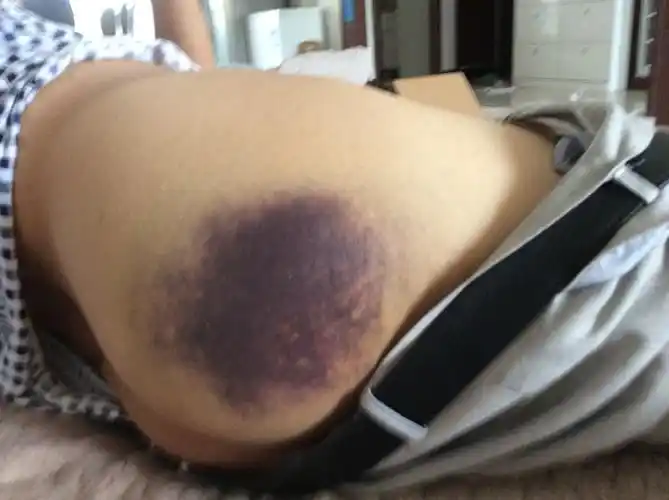 在家不慎摔倒,第三天出现右臀部大面积发黑紫,右臀部好像肿胀,走路