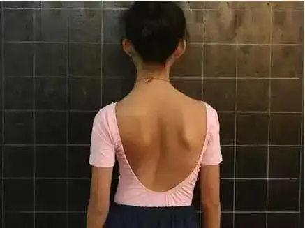 孩子站没站相坐没坐相要警惕颈椎侧弯毁终生