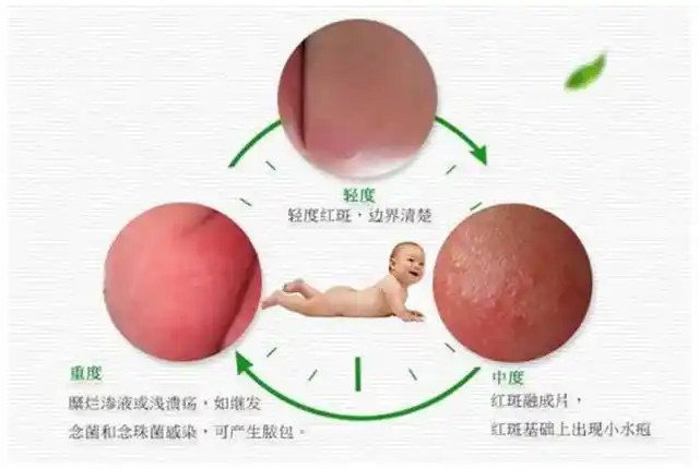 尿布疹和"纸尿裤过敏"你分清了吗?选对纸尿裤,跟红屁屁说拜!