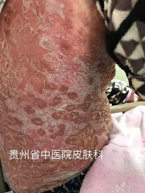 好好珍惜寻常型银屑病(牛皮癣)