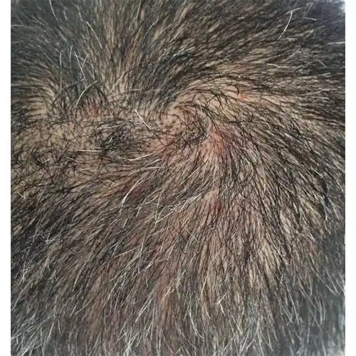 洗发水对敏感头皮屑有帮助吗?去屑洗发露排名前10名