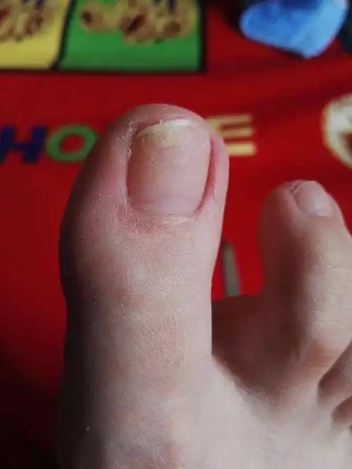 灰指甲初期图片脚趾头