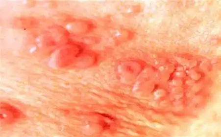 治疗期间,禁止性生活尖锐湿疣患者,尤其是在疣体未完全消退时,应禁止