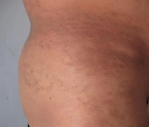 右侧腰胯部皮肤色素沉着--照片太大