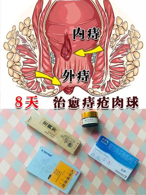 8天治愈痔疮肉球让它永不再来