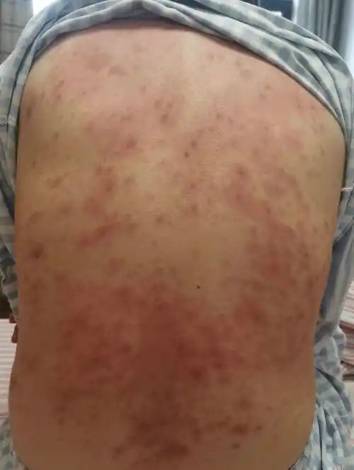 确诊半年后小结-系统性红斑狼疮康复圈-觅健