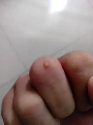 手指上长个疙瘩.我们家乡叫鱼鳞.我见过好几个人都长有.不痛不痒.