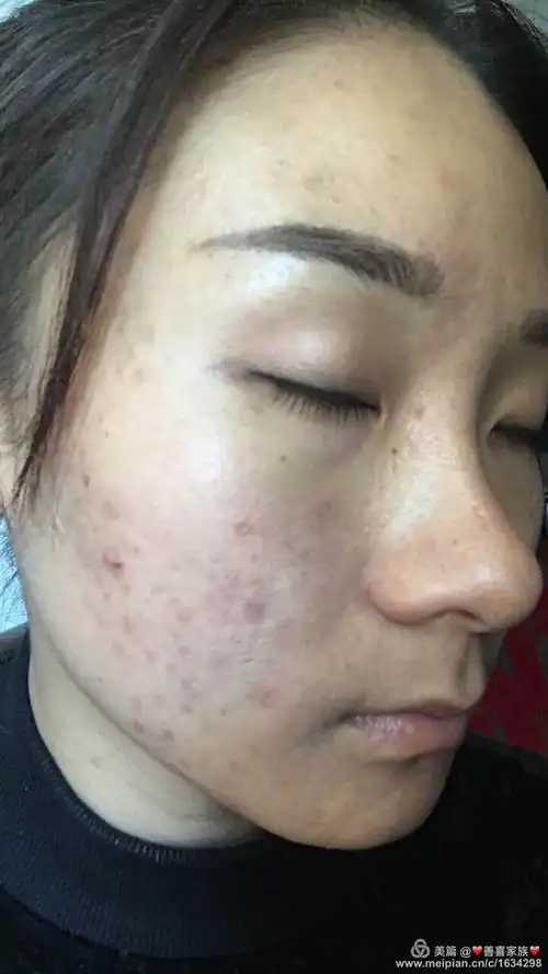 痘痘肌客户排毒代谢期