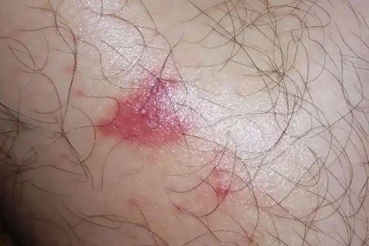 被蚊子咬了深红色血斑