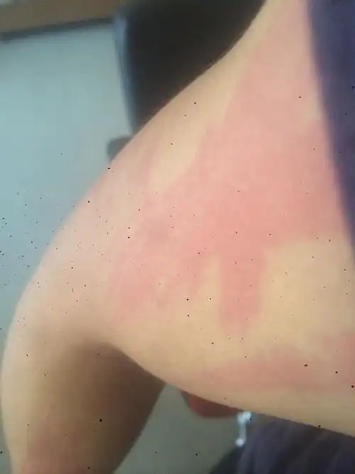 前几天皮肤过敏过,原因是穿一件刚买回来的新衣服,麻料的,现在疙瘩没