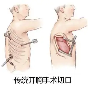 肺腑之谈胸中有术肺癌手术的常见方式及术后并发症