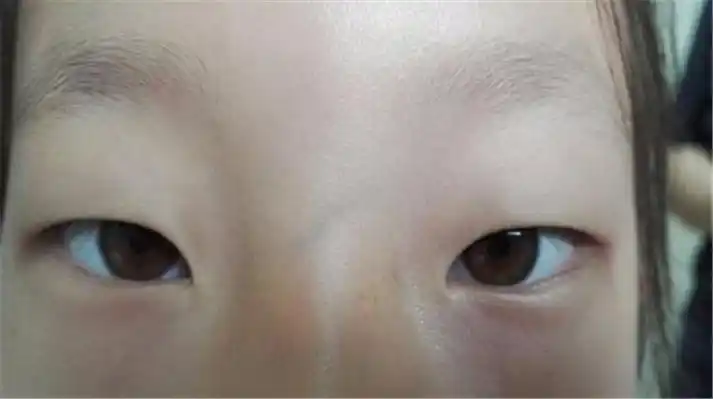 育儿小知识:宝宝鼻梁上有青筋,老中医几招教你调理