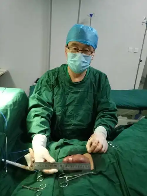 本人刚做的半隐匿性阴茎的延长效果