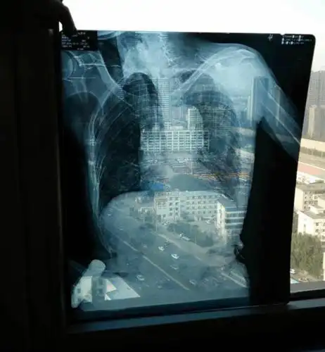 妈妈说在医院门口特地找了两个老奶奶拿片子三个人共同完成这个大作.