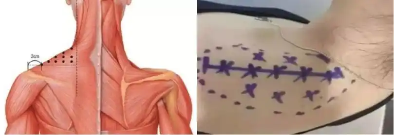 申洋解读瘦肩针注射位点的选择与注射技术的讲解