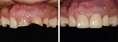 西安圣贝口腔医院牙齿修复案例对比