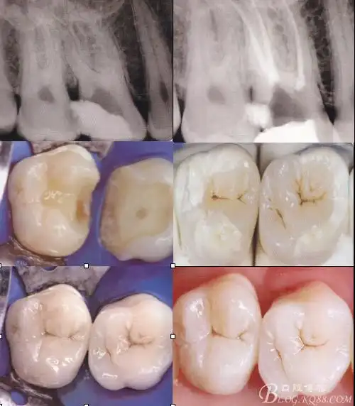 根管治疗后微创修复嵌体高嵌体