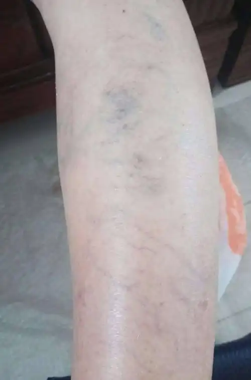 静脉曲张:小小青筋为何变得如此严重