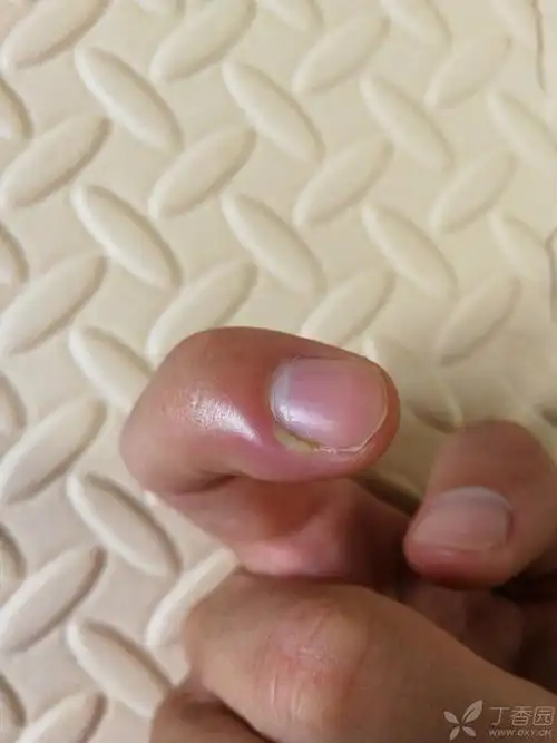 这个是甲沟炎吗?很痛,怎么治