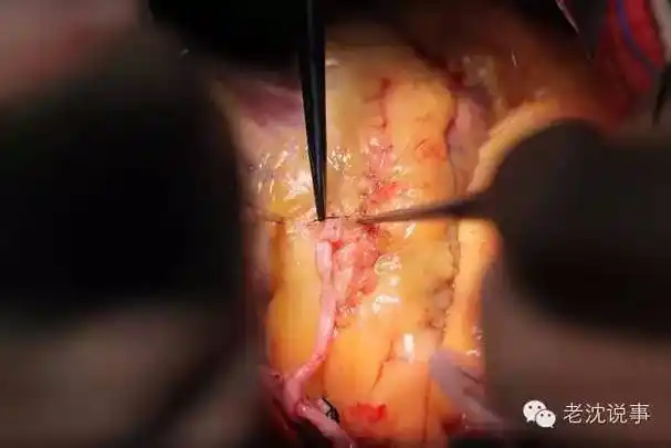 实拍心脏搭桥手术全程震撼胆小勿入