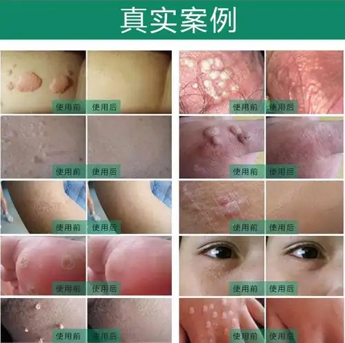 尖锐清疣鬼臼毒素酊克疣液尖锐湿疣去瘊谷得堂除鸡祛尤露寻常疣趾