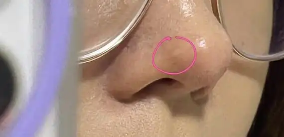 肋骨鼻半年后鼻头能摸到突起的小包
