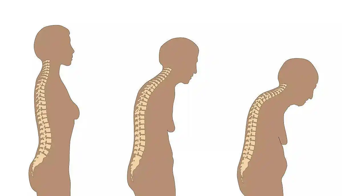 腰酸背痛变矮驼背一定要重视别等骨头酥了才开始进补