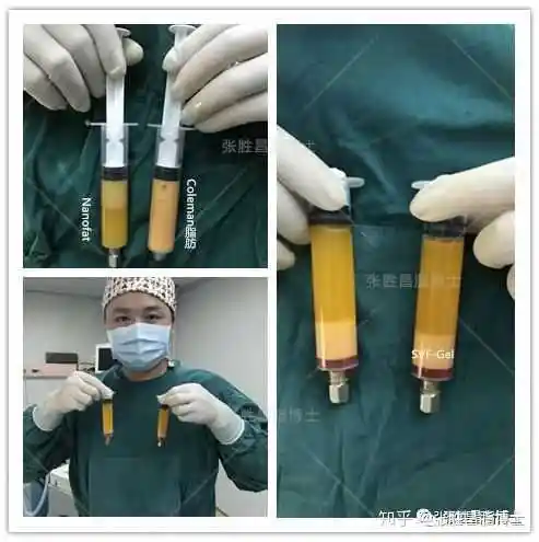 自体脂肪丰面的恢复期要多久?