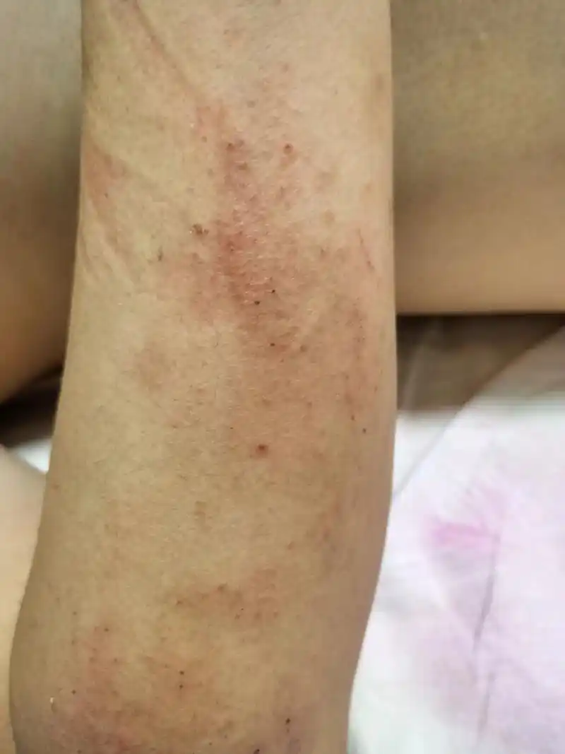 偷拍孙先生长满全身痱子的模样,心疼至极……这张照片没有删的原 - 抖