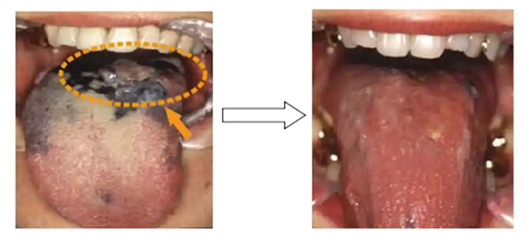 口腔黑色素瘤治疗前后对比图片