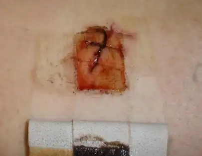 刀伤13天后,伤口不愈合,渗血怎么办.