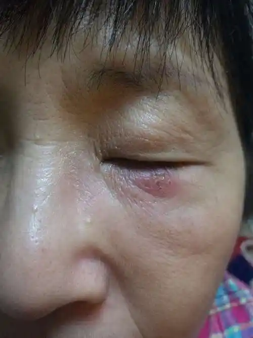 林医生您好我妈妈三天前早上起来发现眼睑下长个东西红肿