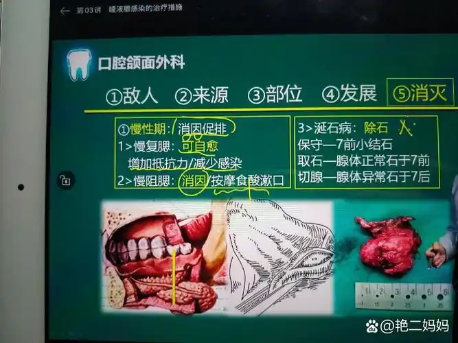 唾液腺感染性疾病的表现及辅助检查 1--急性化脓性腮腺炎(导管 腺泡)